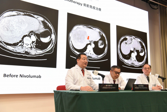 隨著「雙重免疫療法組合」效果顯著，新組合治療已獲得FDA、EMA和NMPA批准用於未接受過醫治的晚期肝癌。研究團隊包括（左起）張丹圖教授、邱宗祥醫生及梁澄宇醫生。
 